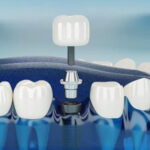 dental implants in Washington, DC