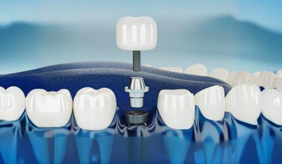 dental implants in Washington, DC